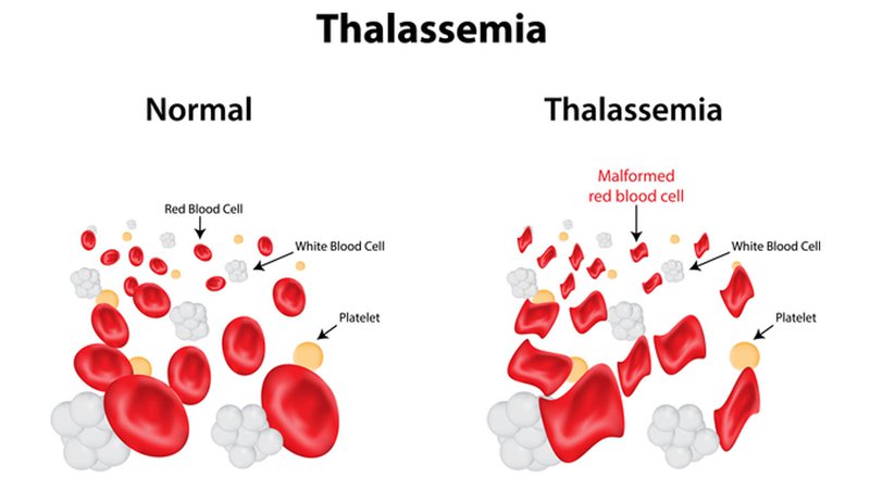 Xét nghiệm bệnh tan máu bẩm sinh Thalassemia ở đâu?