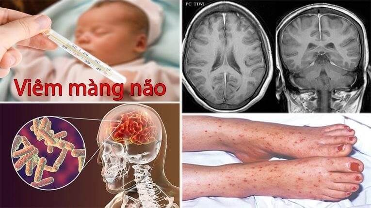 Trẻ đau đầu và sợ ánh sáng – Đừng bỏ qua bệnh Viêm màng não