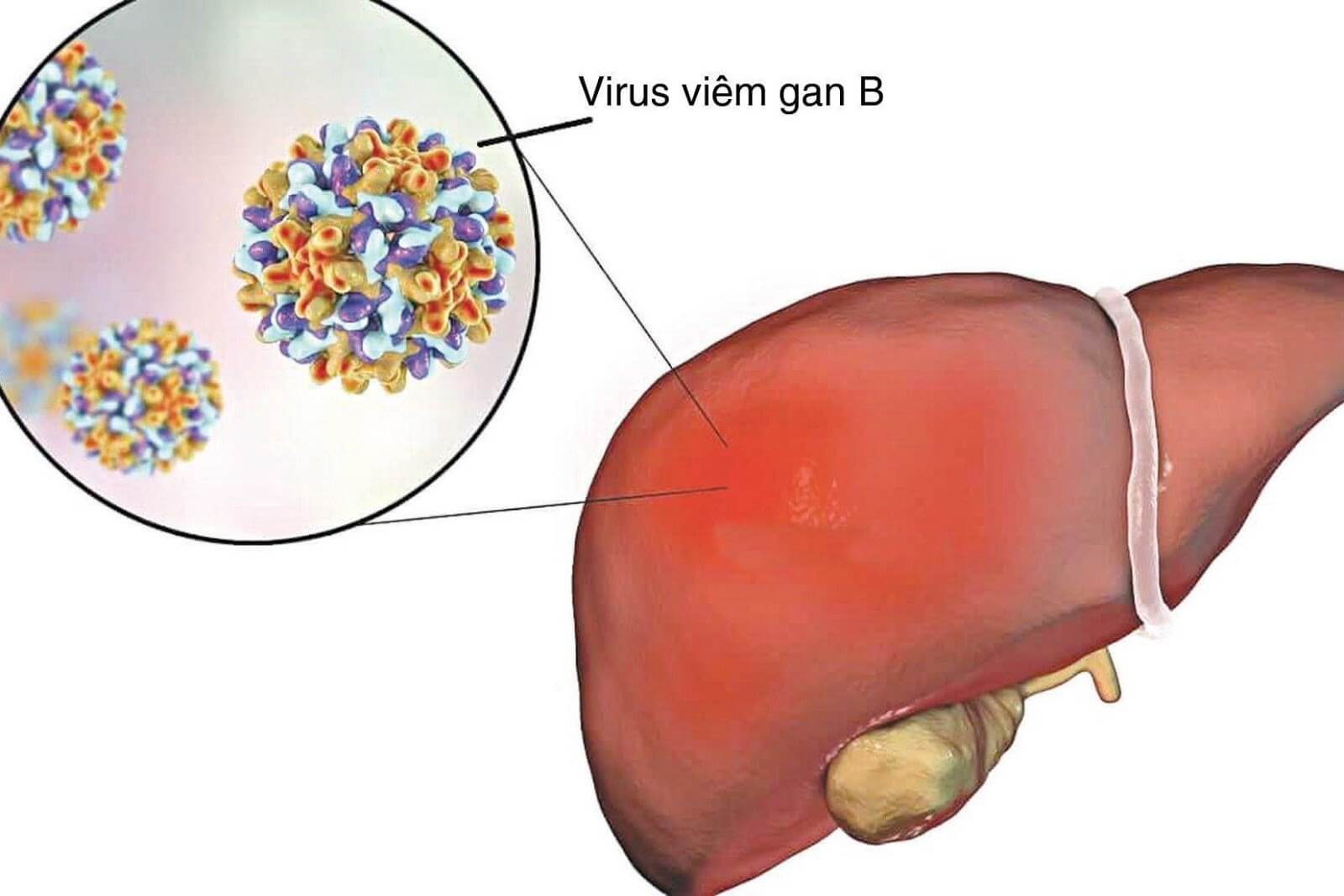 Anti HBs là gì? Cách xem kết quả xét nghiệm Anti HBs