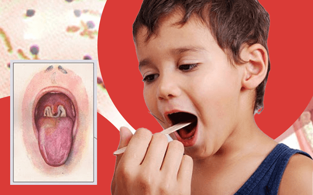 Bệnh bạch hầu là gì? Địa điểm khám ngăn ngừa bệnh bạch hầu