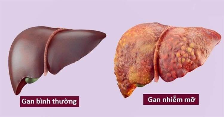 Gan nhiễm mỡ độ 1 là gì? Nguyên nhân và phương pháp điều trị hợp lý