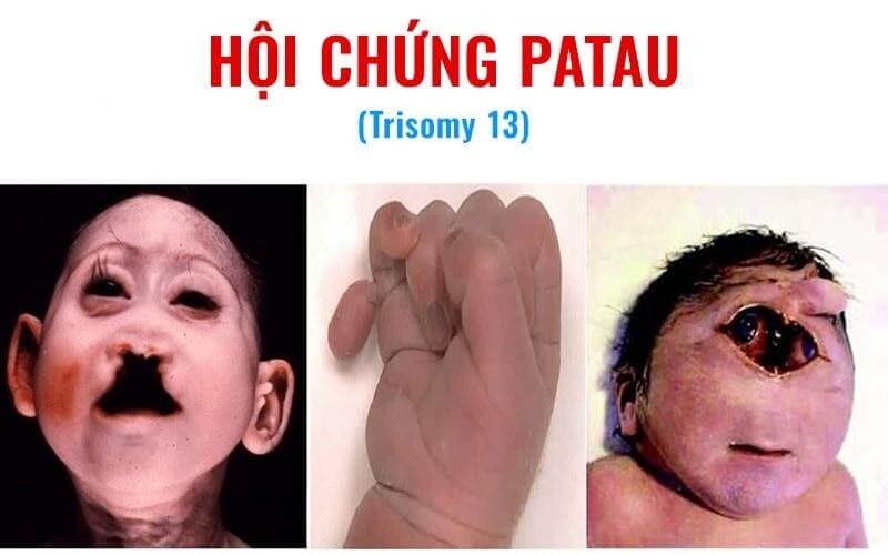 Hội chứng patau là gì? Chẩn đoán và điều trị hội chứng patau