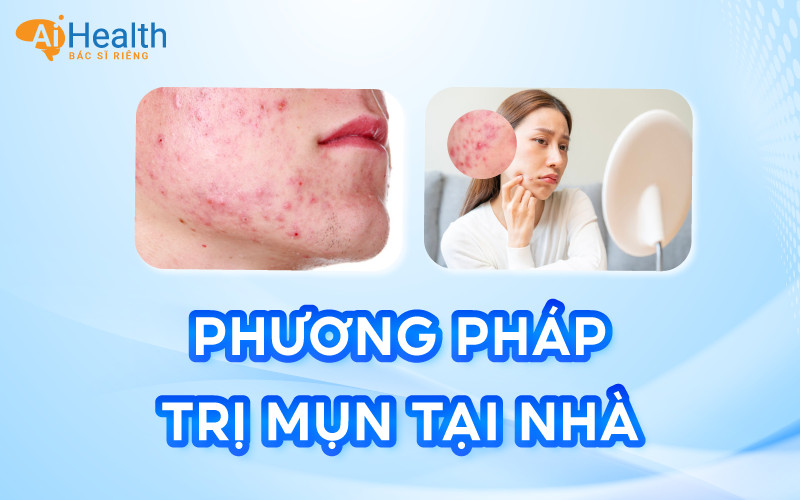 8 Cách trị mụn tại nhà do chuyên gia đề xuất